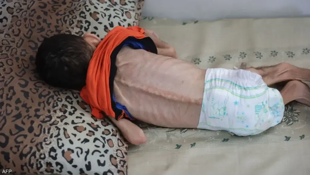 صوت غزة 17 حالات سوء التغذية في غزة للأطفال